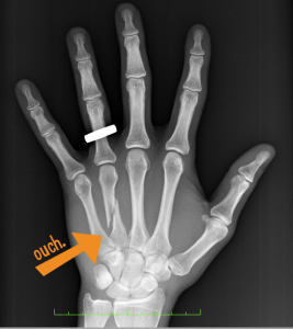 broken hand